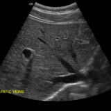 腹部超音波検査の概要と腹痛の関連性
