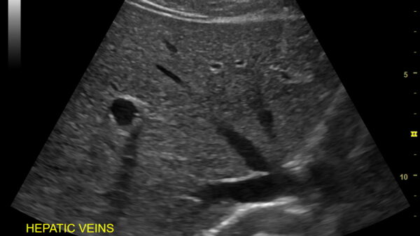腹部超音波検査の概要と腹痛の関連性