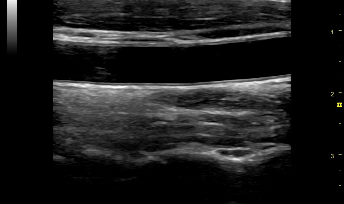 臨床検査技師が頸動脈エコーで血管の状態を確認し、動脈硬化の有無を評価している様子