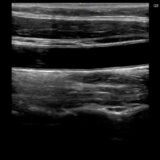 頸動脈エコーで動脈硬化の早期発見！検査の流れと意義