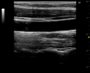 臨床検査技師が頸動脈エコーで血管の状態を確認し、動脈硬化の有無を評価している様子