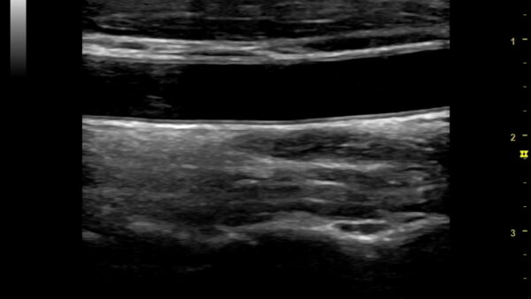 頸動脈エコーで動脈硬化の早期発見！検査の流れと意義