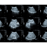 エコーで見えた「頑張りすぎ社員」の身体