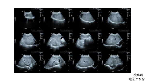 エコーで見えた「頑張りすぎ社員」の身体
